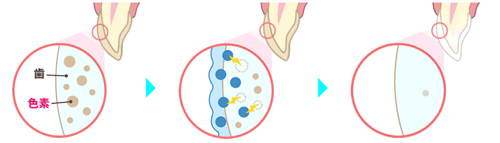 歯を白くする原理